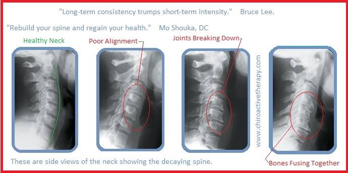 Stages of neck degeneration X-ray chiropractor chiropractic Tustin CA 92780