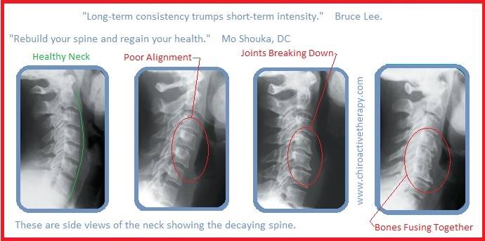 Neck xrays Stages of neck degeneration X-ray chiropractor chiropractic Tustin CA 92780