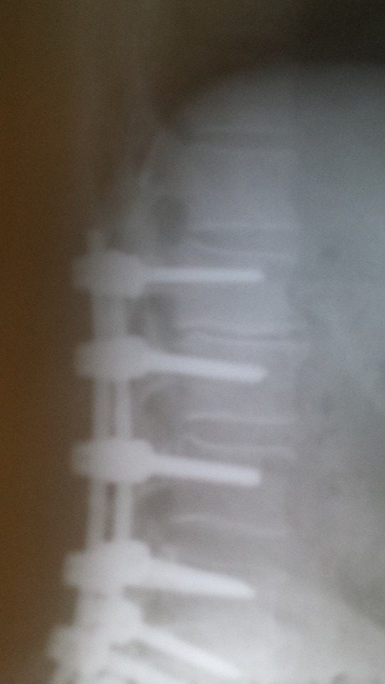 Post surgical fusion of lumbar spine