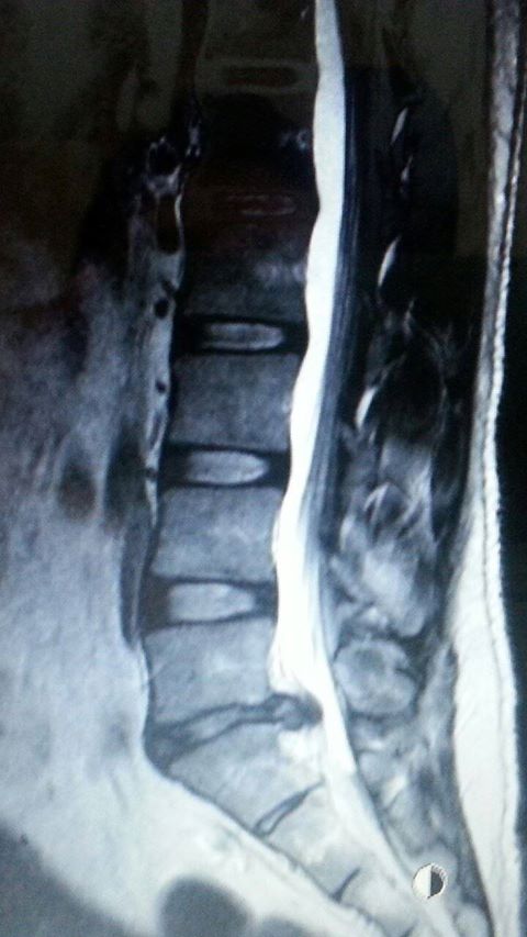 Herniated disc in lumbar spine